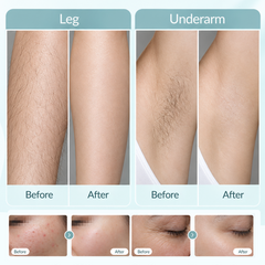 At-Home IPL Laser Hair Removal Device | 900,000 Flashes, 8 Power Levels, Whole-Body Hair Remover for Men & Women