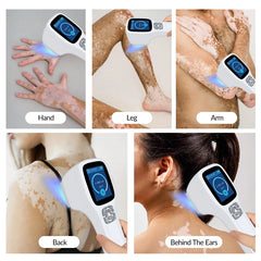 ZJZK 308 nm Excimer-Gerät – Effektive natürliche Lichttherapie für Psoriasis, Vitiligo und Ekzeme zu Hause