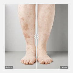 ZJZK Portable 308nm Excimer UVB Light- Vitiligo/Psoriasis Light Therapy Device